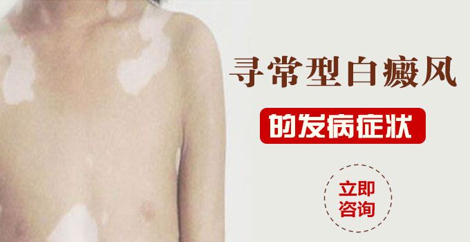 寻常型白癜风的发病症状？