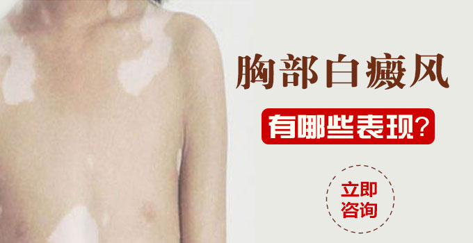 胸部白癜风有哪些表现?